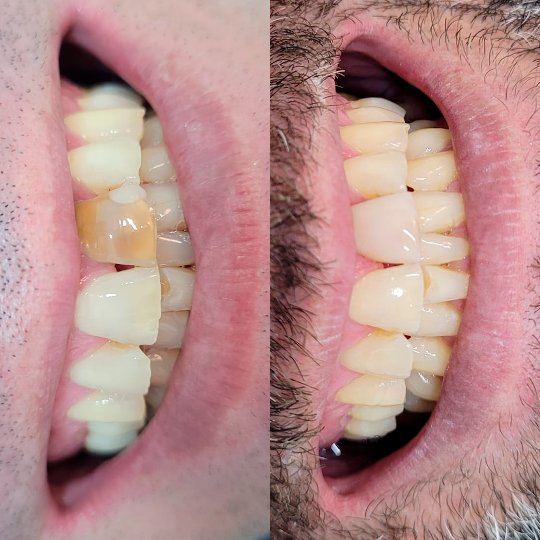 Transformação de sorriso - antes e depois
