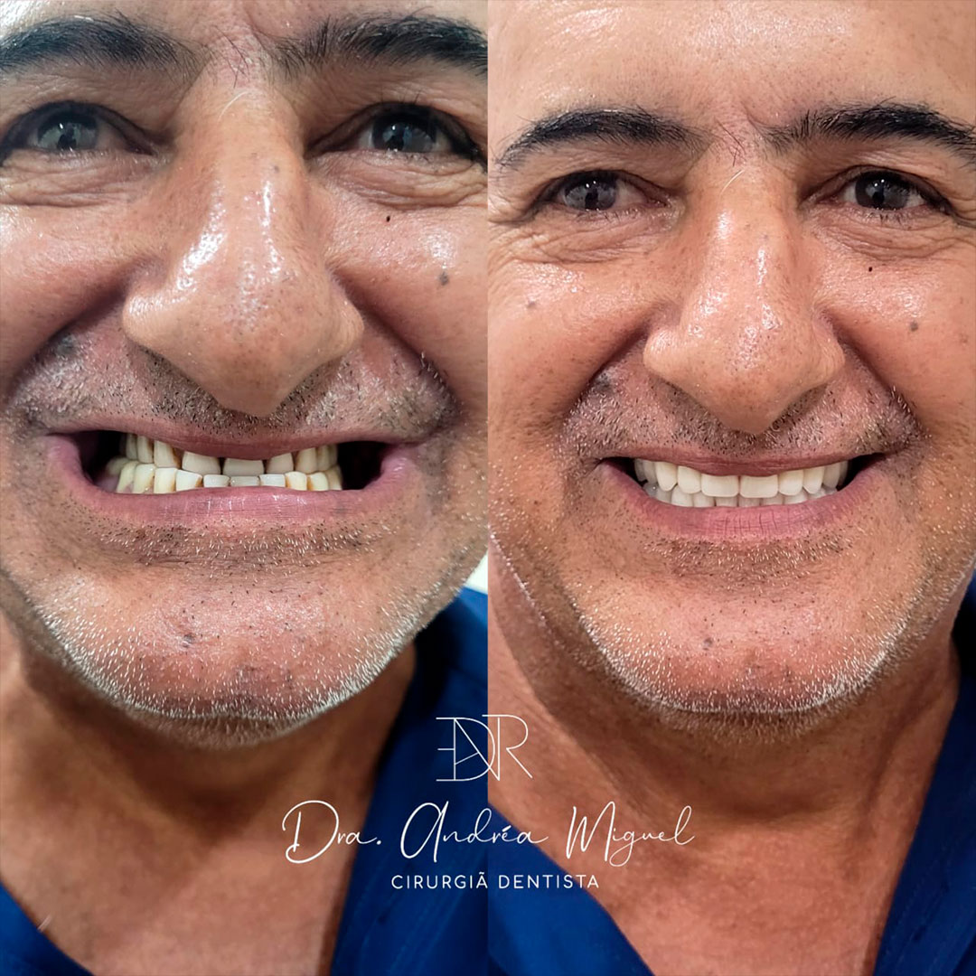 Transformação de sorriso - antes e depois