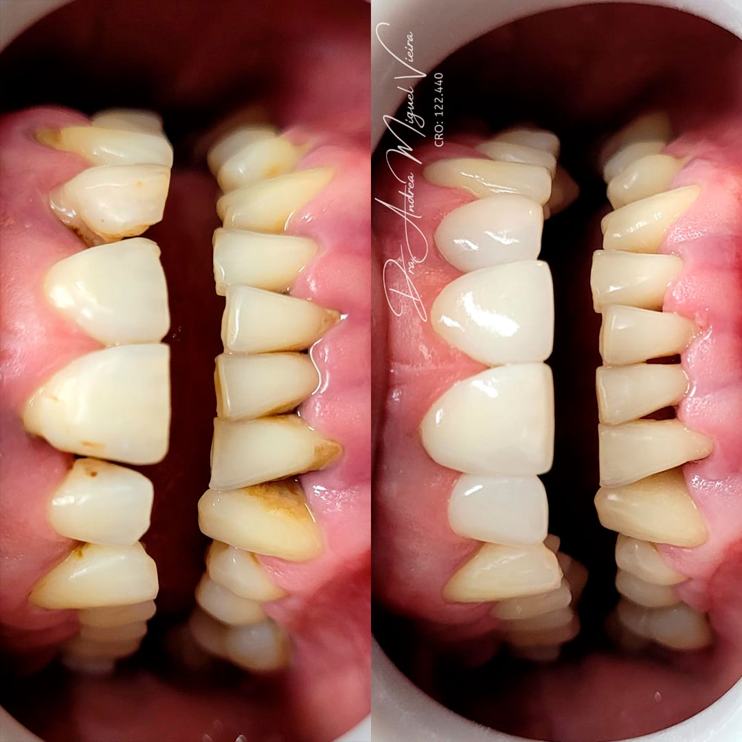 Transformação de sorriso - antes e depois