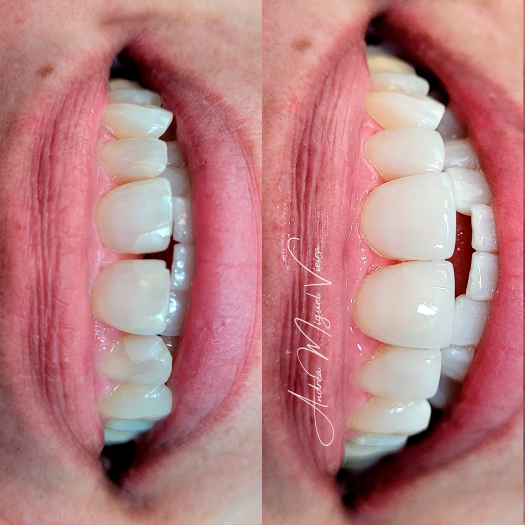 Transformação de sorriso - antes e depois